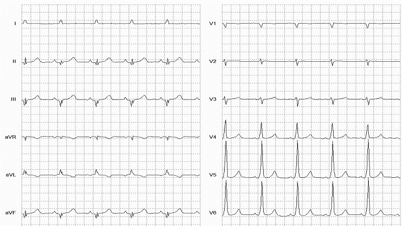 Wolff-Parkinson-White (WPW) 12 Lead EKG_fig2